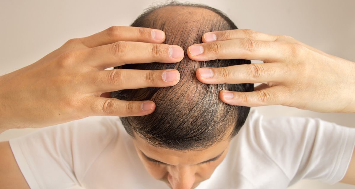 Kok Bisa Sih, Belum Kepala Tiga Rambut Udah Botak?