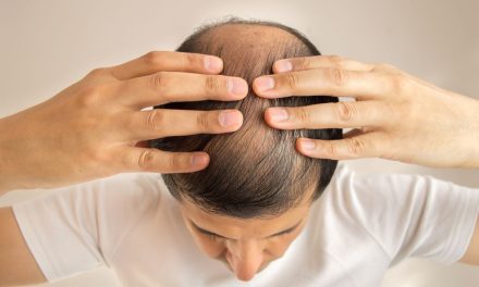 Kok Bisa Sih, Belum Kepala Tiga Rambut Udah Botak?