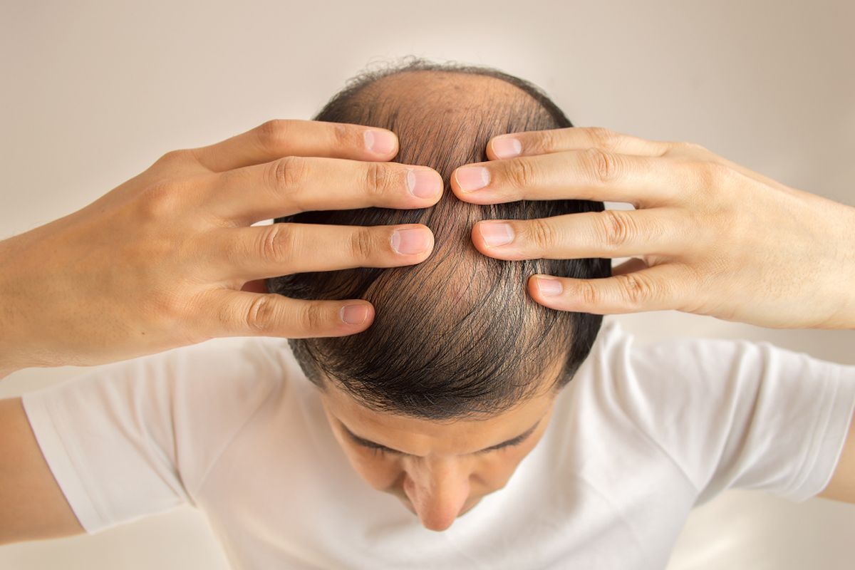 Kok Bisa Sih, Belum Kepala Tiga Rambut Udah Botak?
